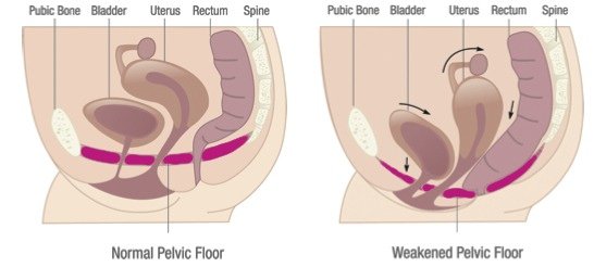 urinary incontinence due to weak pelvic floor