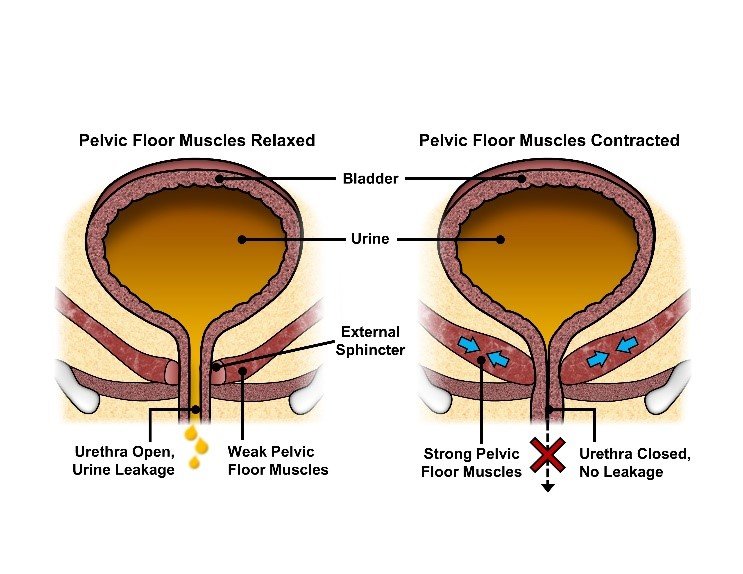 Pelvic Muscle Weakness