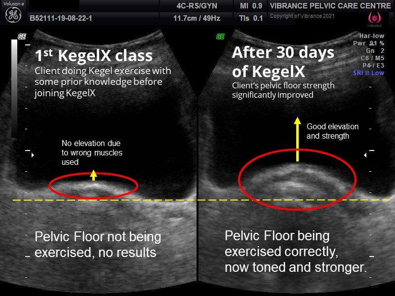 Exercises after before and kegel Step