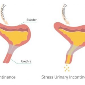 Urinary Incontinence Treatment – Online Booking Special (First Time Customer Only)