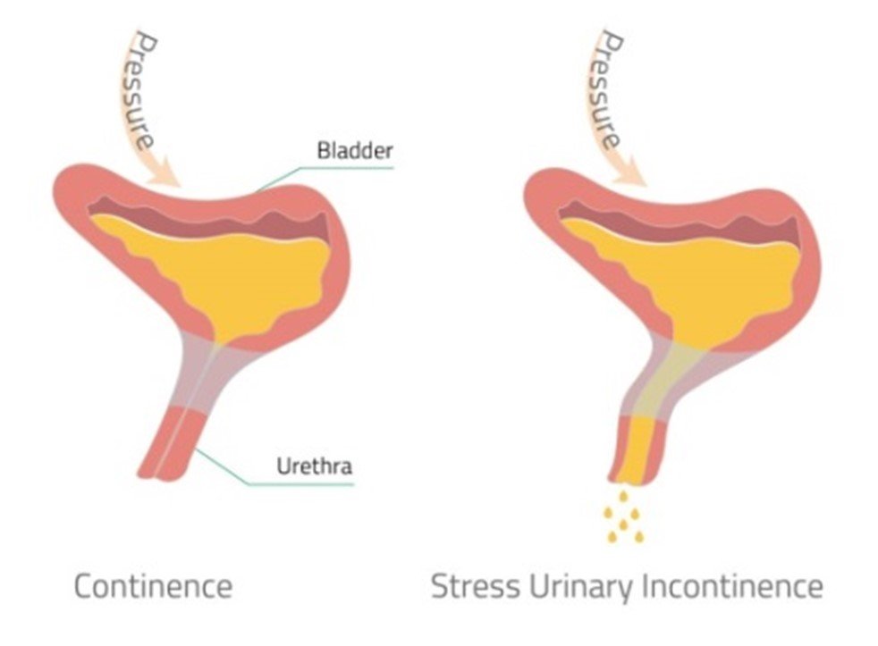 Coital Incontinence Relief For Women