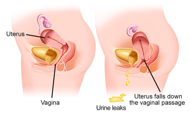 urinary incontinence pelvic organ prolapse
