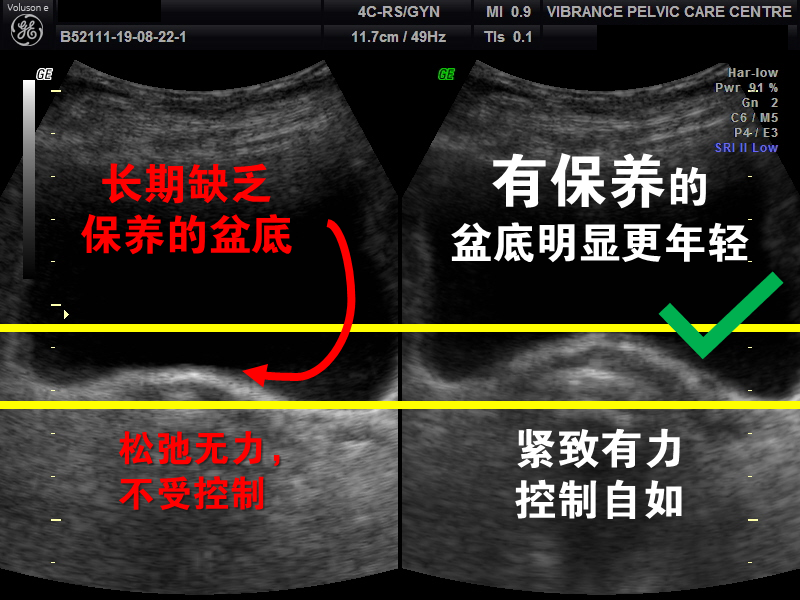 盆底保养和没保养