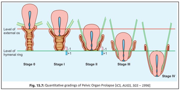 stages of uterine prolapse rahim jatuh