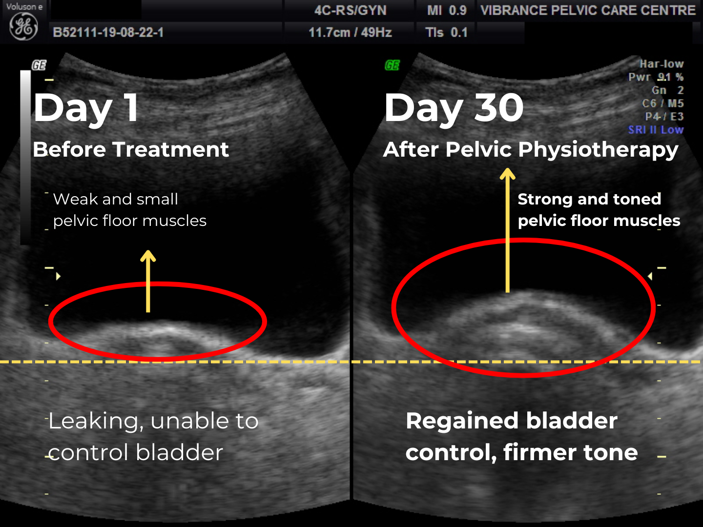 Pelvic Floor Muscles Before After Vibrance Pelvic Physiotherapy