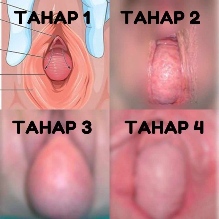 rahim jatuh tahap 1-4